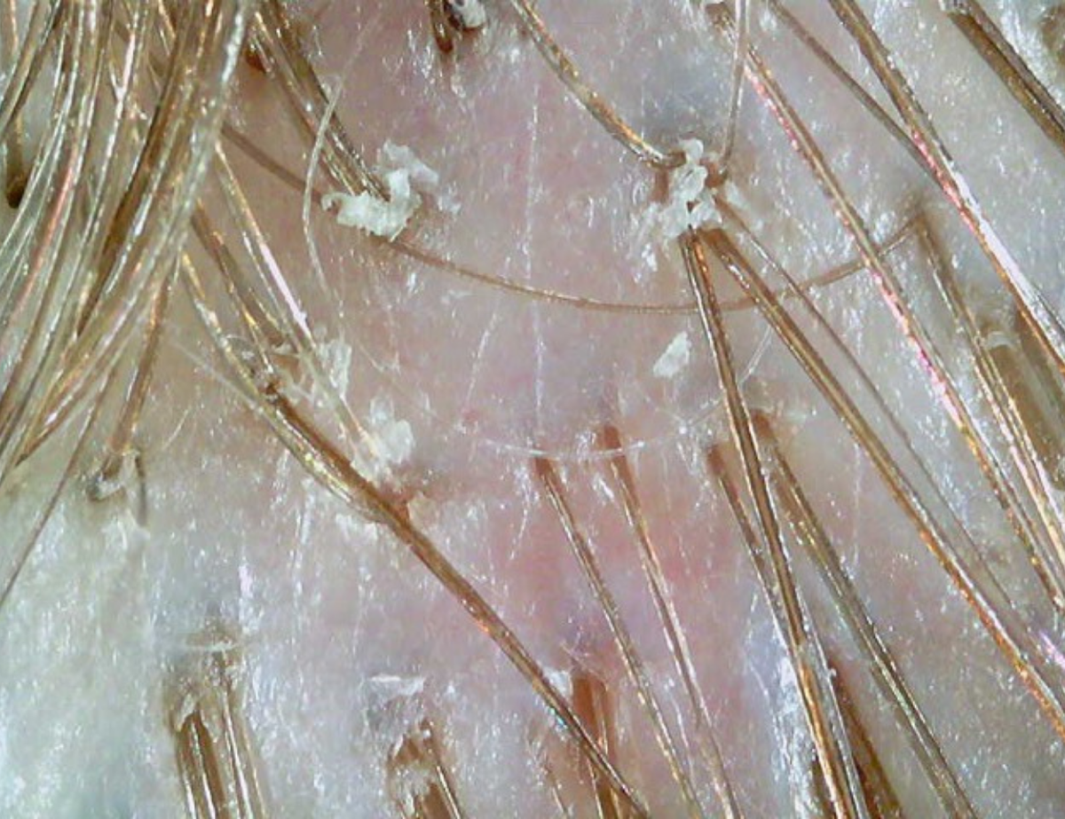 Før peeling